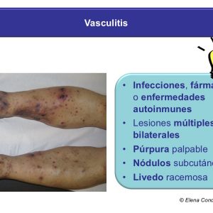 Vasculitis necrosis