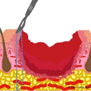 biopsia profunda úlcera