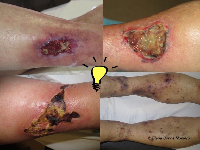 Necrosis and purple edges in leg ulcers: keys to guide your diagnosis