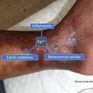 ion iron venous disease