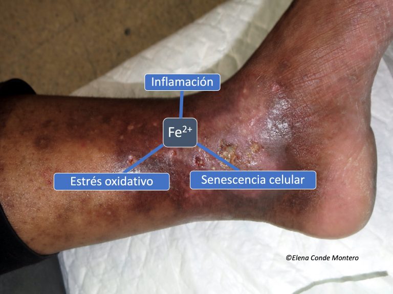 Hierro, dermatitis ocre y úlcera venosa