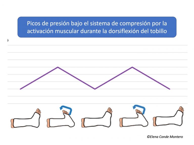 ¿Qué ejercicios puedo hacer en casa contra el flebolinfedema?