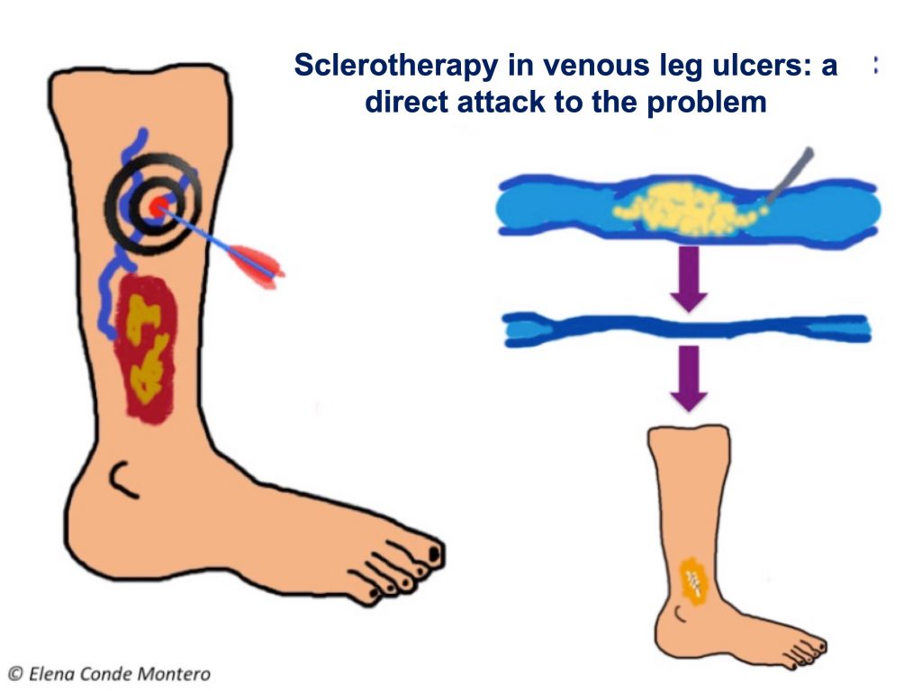 Sclerotherapy gains against recurrence of venous leg ulcers - Elena Conde