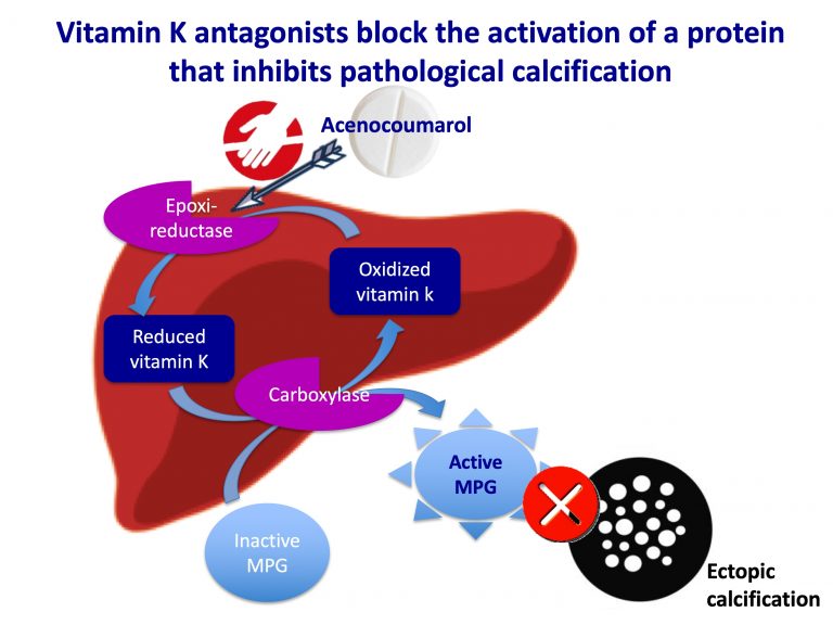 Martorell Ulcer and Vitamin K Antagonists: A Dangerous Combination