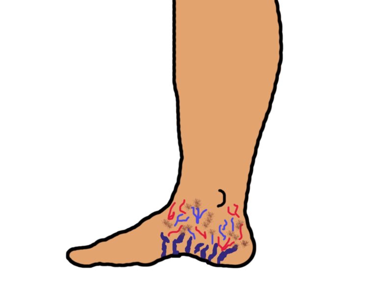 Corona phlebectatica: sign of advanced chronic venous insufficiency