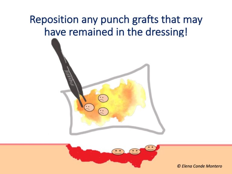 Repositioning and not removing scabs: two unwritten rules of punch grafting