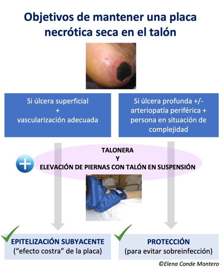 No desbrides placas necróticas secas en talones