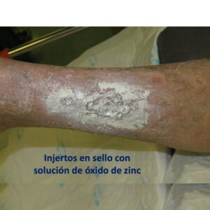 injertos en sello con óxido de zinc