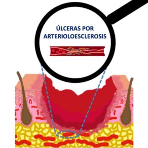 arterioloesclerosis