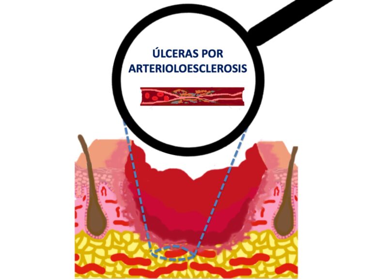 Poco se habla de las úlceras por arterioloesclerosis