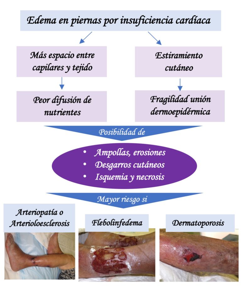 ¿Úlceras en pierna por insuficiencia cardíaca?