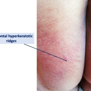 Hyperkeratotic ridges horizontal