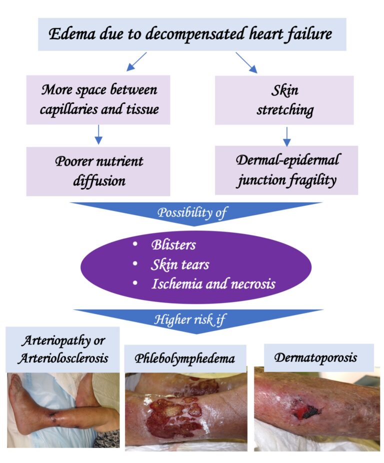 Leg ulcers due to heart failure?