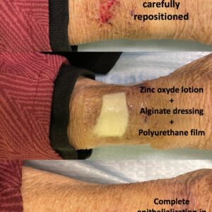 skin tear alginate