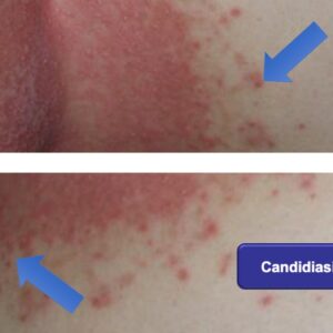 candidiasis