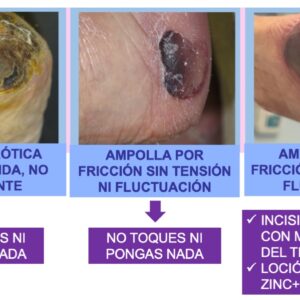 tratamiento lesiones por fricción talones