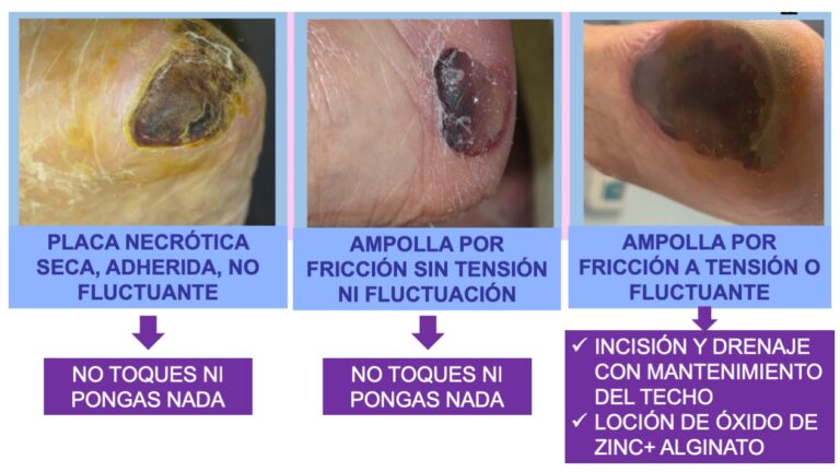 Lesiones en los talones asociadas a la dependencia