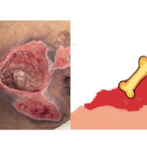 úlcera sacra con hueso expuesto