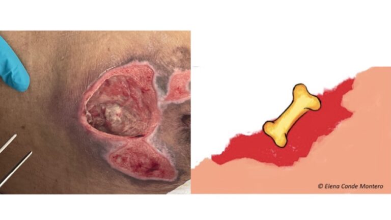 ¿Úlcera por presión en sacro con hueso expuesto?