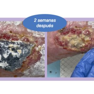 efecto costra en necrosis de colgajo